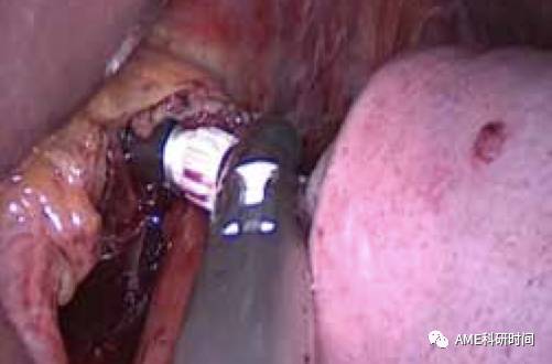 管型吻合器怎么用完全腹腔镜下全胃切除术后的消化道重建——7种食管空肠吻合方法_https://www.jmylbn.com_新闻资讯_第35张