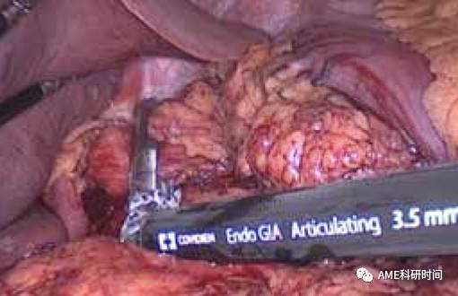 管型吻合器怎么用完全腹腔镜下全胃切除术后的消化道重建——7种食管空肠吻合方法_https://www.jmylbn.com_新闻资讯_第3张