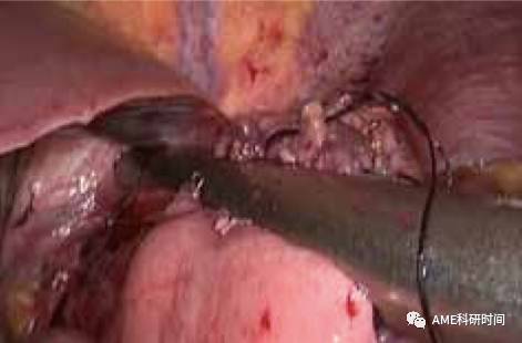 管型吻合器怎么用完全腹腔镜下全胃切除术后的消化道重建——7种食管空肠吻合方法_https://www.jmylbn.com_新闻资讯_第47张