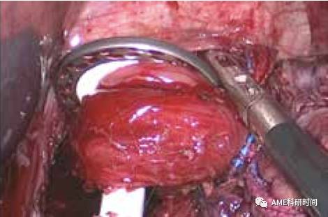 管型吻合器怎么用完全腹腔镜下全胃切除术后的消化道重建——7种食管空肠吻合方法_https://www.jmylbn.com_新闻资讯_第10张