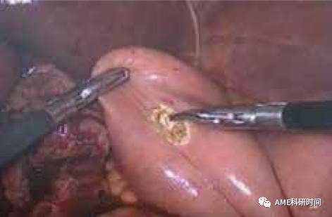 管型吻合器怎么用完全腹腔镜下全胃切除术后的消化道重建——7种食管空肠吻合方法_https://www.jmylbn.com_新闻资讯_第45张