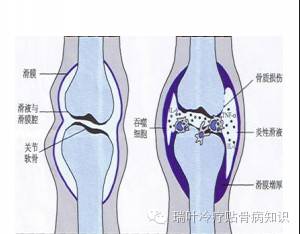 滑膜炎得中医治疗方法
