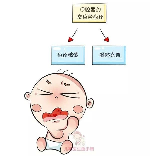 【健康】宝宝突然发高烧,喉咙"长泡泡".得了疱疹