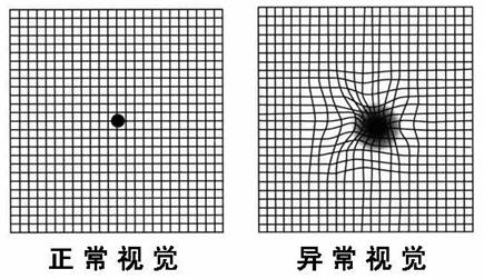 若方格表中心区出现空缺或曲线,可能预示着黄斑病变