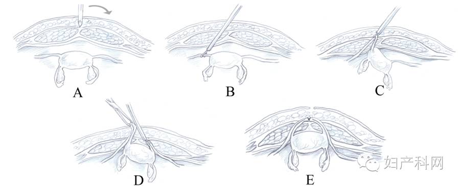 图1圆韧带法脱垂子宫腹前壁悬吊固定术示意图(康楷绘)