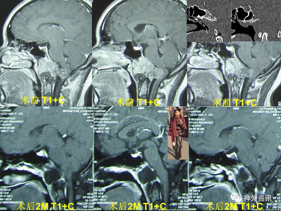 王义宝教授下斜坡颅底内外沟通性脊索瘤的内镜经鼻一期手术治疗