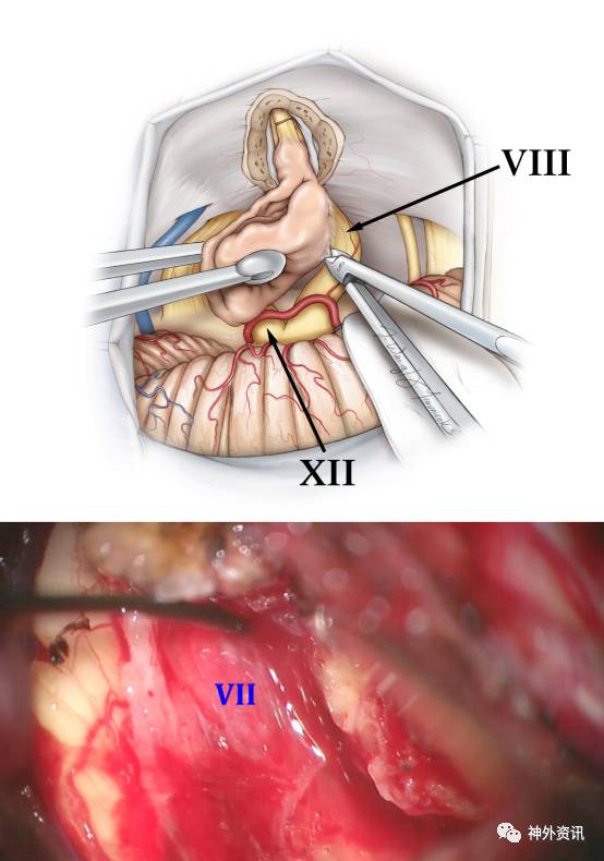 乙状窦后入路切除听神经瘤手术策略与技巧丨theneurosurgicalatlas