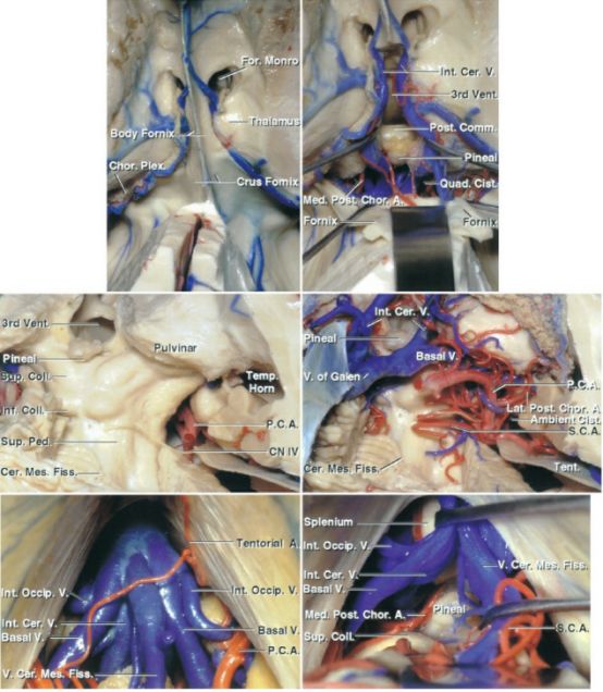 松果体区肿瘤手术入路策略与技巧theneurosurgicalatlas全文翻译