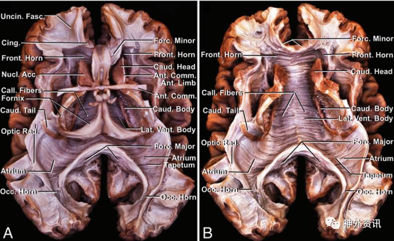 大脑白质纤维束与侧脑室手术二