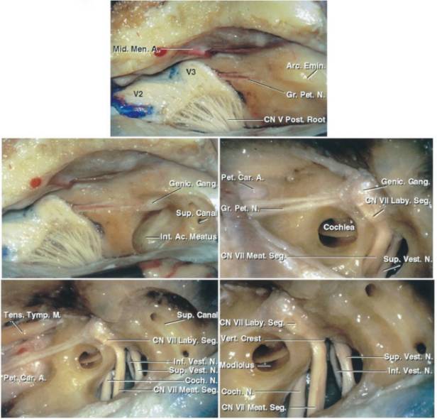 中颅底入路切除听神经瘤手术策略与技巧 the neurosurgical atlas