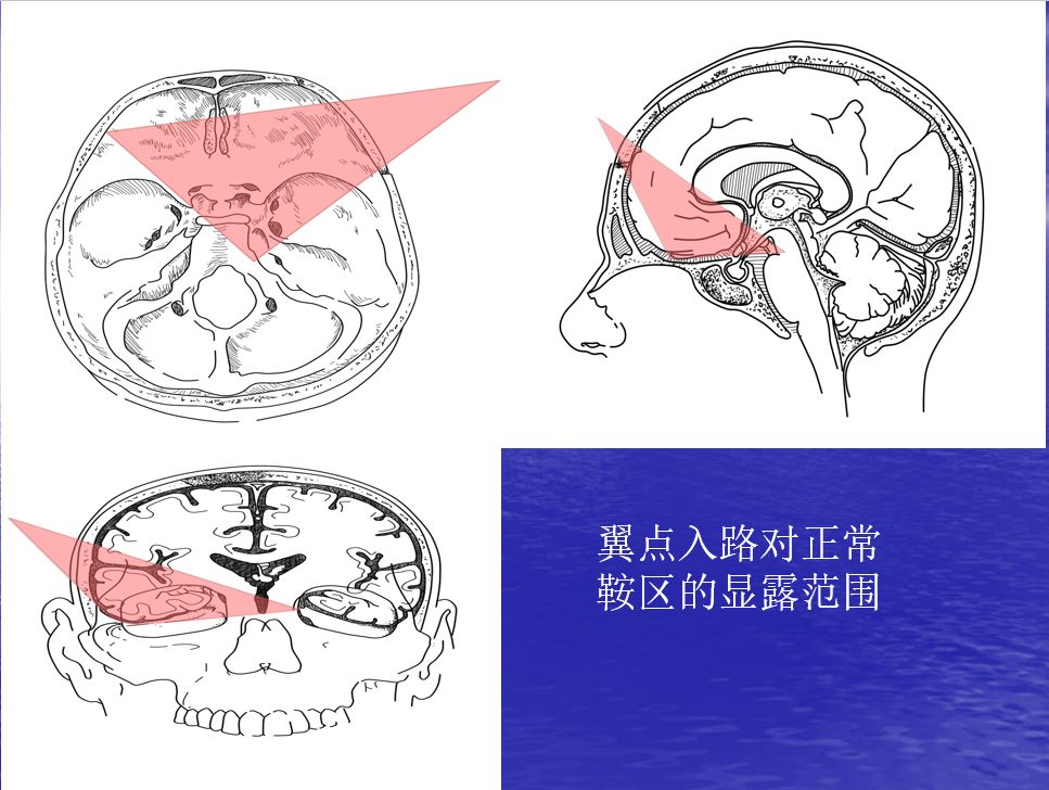 【8月15日】赵洪洋 | 颅咽管瘤手术入路-翼点入路能走