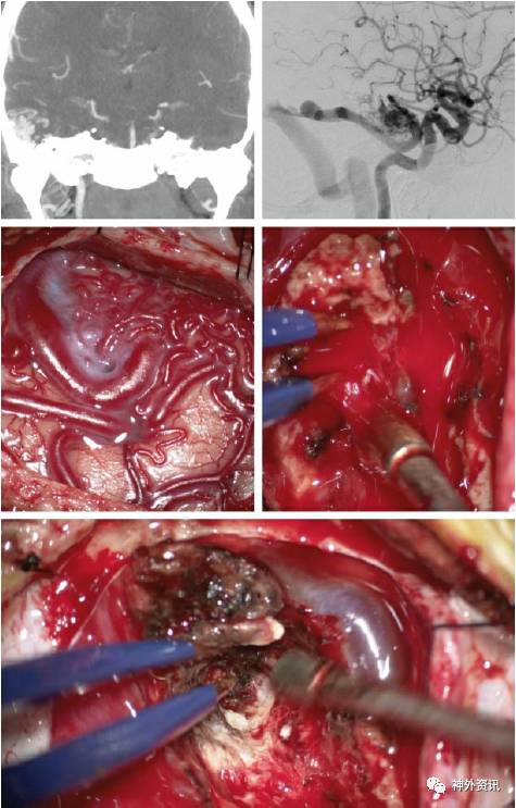 aaroncohen教授脑动静脉畸形avm术中破裂的紧急处理中英文字幕