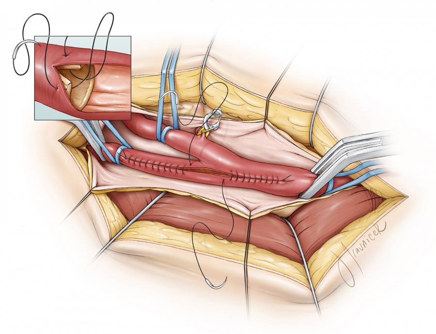 颈动脉内膜剥脱策略与技巧carotidendarterectomy丨theneurosurgical