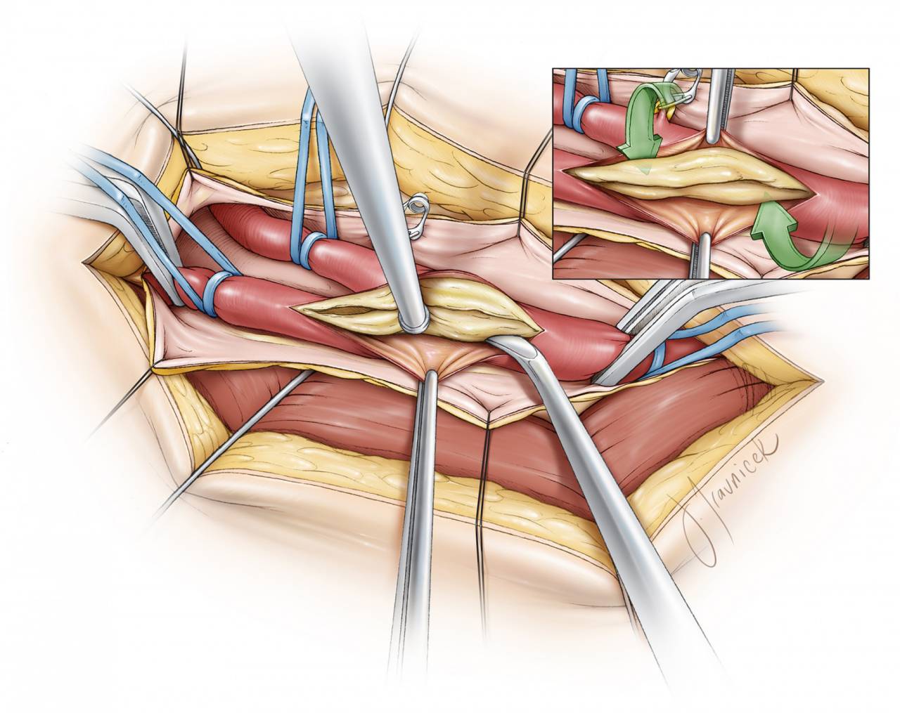 颈动脉内膜剥脱策略与技巧carotidendarterectomy丨theneurosurgical