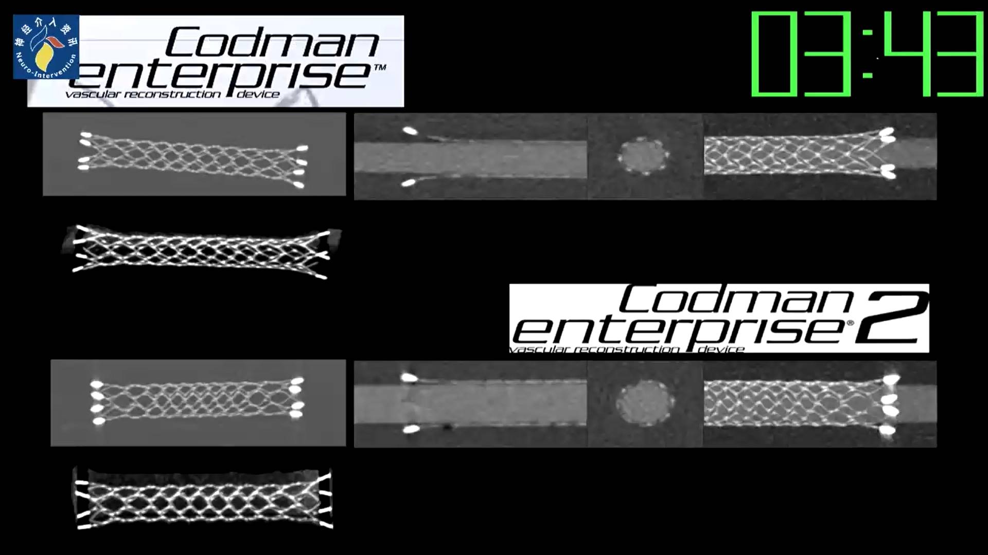 【强生医疗cnv-神经介入专栏】| nobuyuki sakai教授:enterprise支架