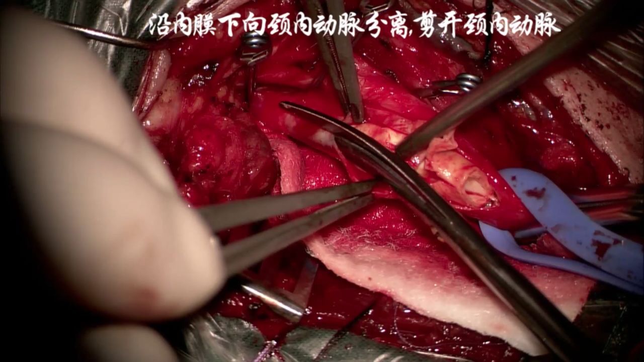 王嵘教授颈动脉内膜剥脱术