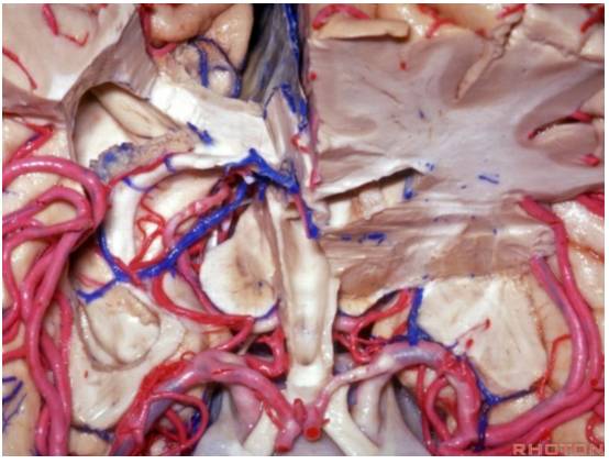 对侧纵裂经大脑镰经楔前叶入路手术策略与技巧 | the neurosurgical