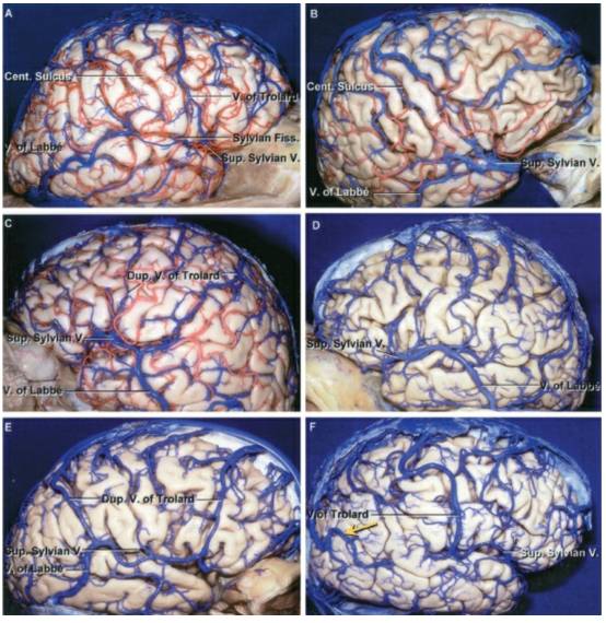 对侧纵裂经大脑镰经楔前叶入路手术策略与技巧 | the neurosurgical