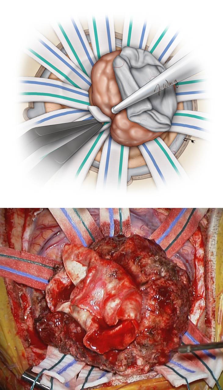 凸面脑膜瘤手术策略与技巧 | the neurosurgical atlas全文翻译