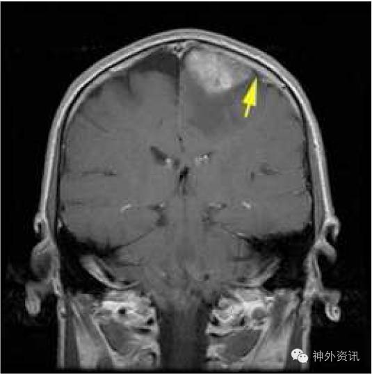 病例2头颅mri-t1增强冠状位图像显示左侧矢状窦旁占位病变,可见硬膜