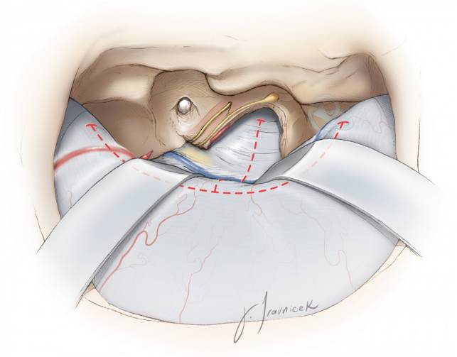 前岩骨切除手术技巧丨the neurosurgical atlas全文翻译