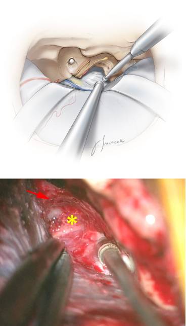 前岩骨切除手术技巧丨theneurosurgicalatlas全文翻译