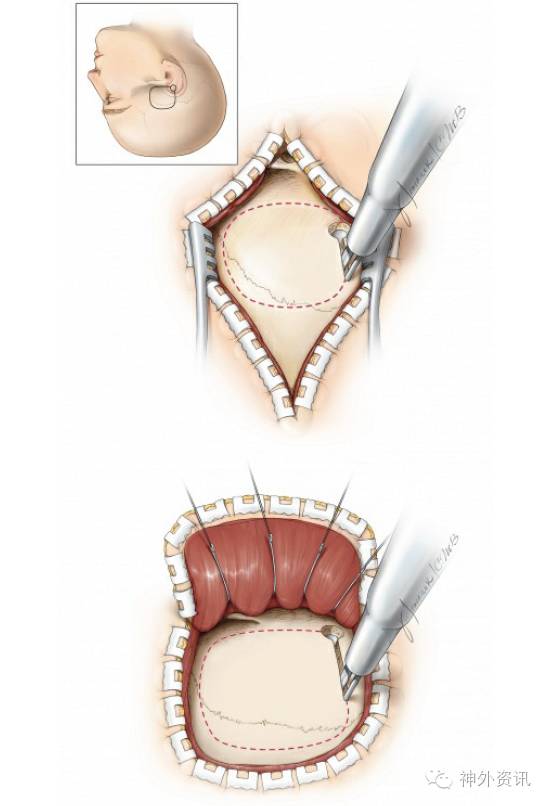 the neurosurgical atlas 系列回顾第一章《神经外科手术原则部分》