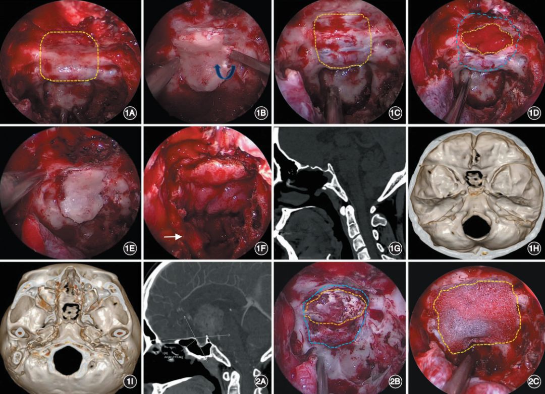 原位骨瓣在经鼻内镜颅咽管瘤手术颅底重建中的应用中华神外2019年第5