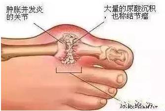 痛风不是一种病，是一串病！如何喝黑茶预防痛风！内附视频