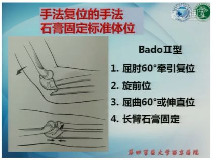 bado ii型孟氏骨折手法复位,石膏固定的标准体位:屈肘60°牵引复位
