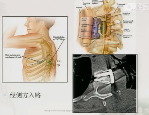 胸腰椎侧前方手术技术—从dlif到olif