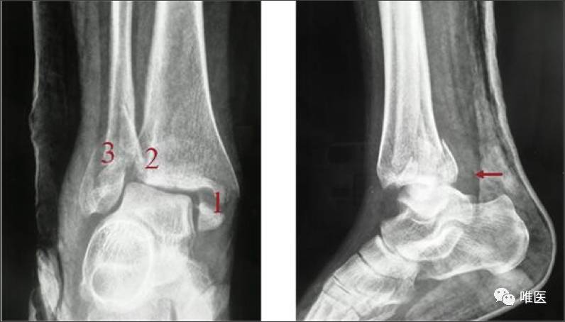 经验分享:三踝骨折的基础和临床治疗