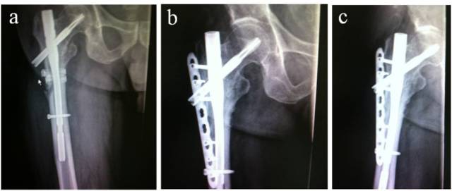综述:粗隆间骨折骨不连的治疗策略