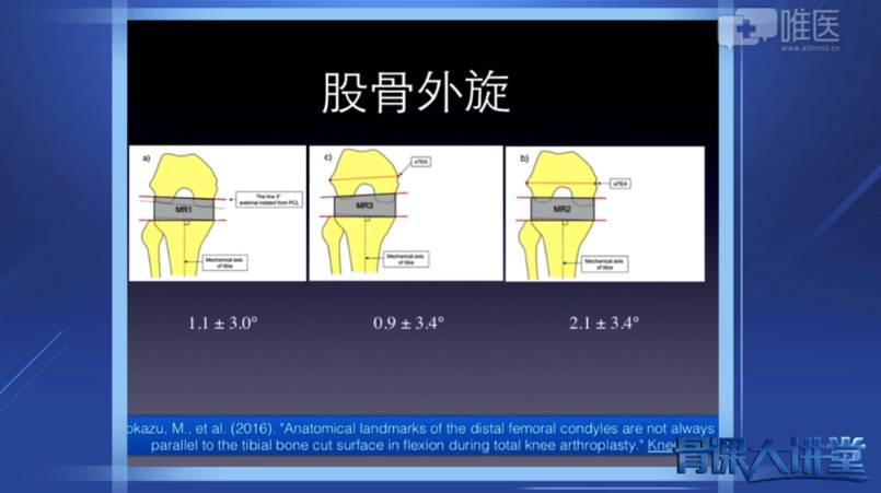运用间隙平衡法的注意点 股骨后髁的预截骨以利于清除后方骨赘 合理