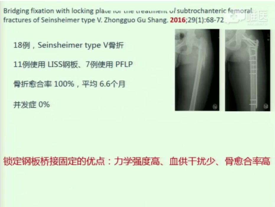 股骨转子下骨折的治疗—我对钢板情有独钟