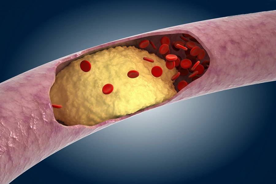3分钟看懂动脉粥样硬化的形成过程