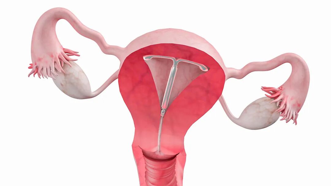 备孕2年无果，并非运气差！详解谌女士不孕真相