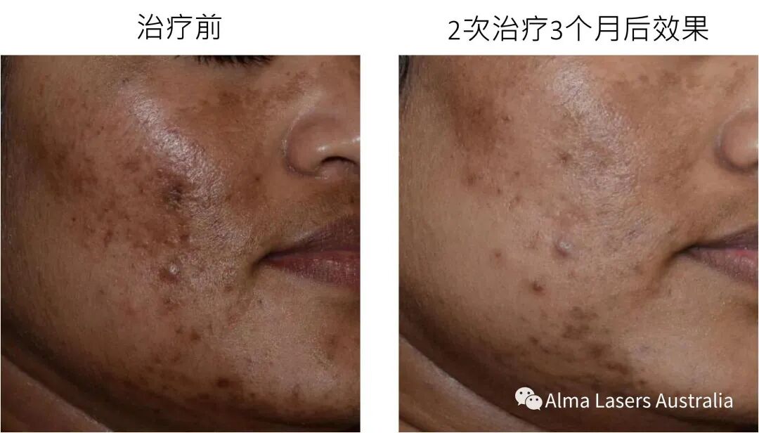 【王牌DPL黑金超光子限时$299买1送1】光子护肤中的爱马仕👉一次治疗等于其它光子3次效果！ - 5