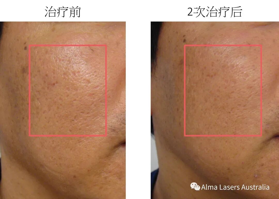 【王牌DPL黑金超光子限时$299买1送1】光子护肤中的爱马仕👉一次治疗等于其它光子3次效果！ - 6