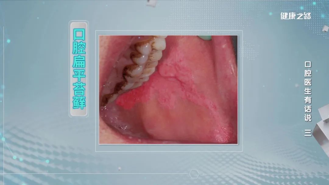 常见的口腔黏膜病变包括口腔扁平苔藓,口腔白斑和口腔红斑.