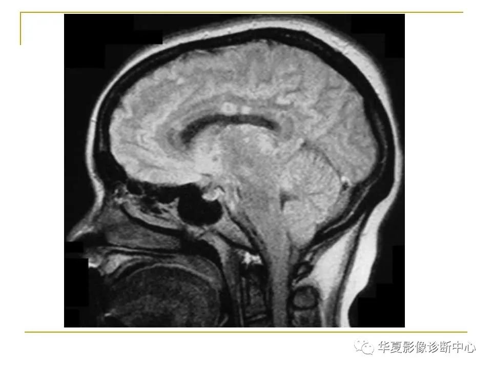 全面详细解析胼胝体各种病变