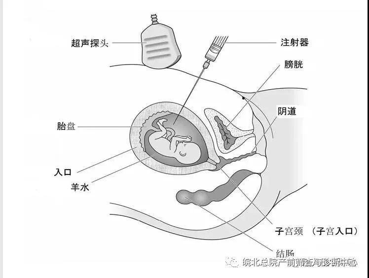 羊膜腔穿刺术检测