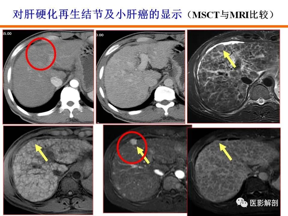 肝硬化结节癌变的早期影像诊断来了