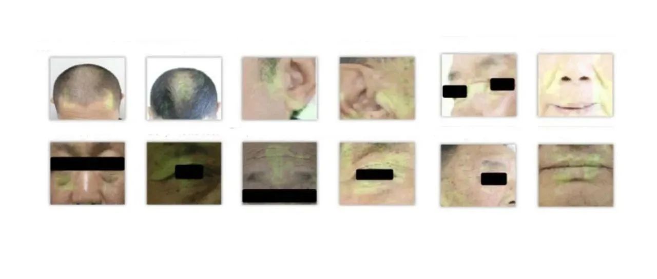 他们找了6000多张脸后发现，看脸部照片能评估一个人的冠心病风险