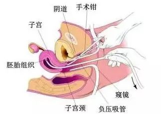 刮宫和人流哪一个对女性伤害更大