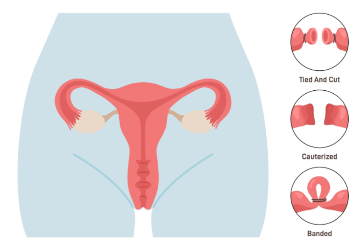 从“通而不畅”到“硕果累累”：一例输卵管性不孕的精准助孕之路