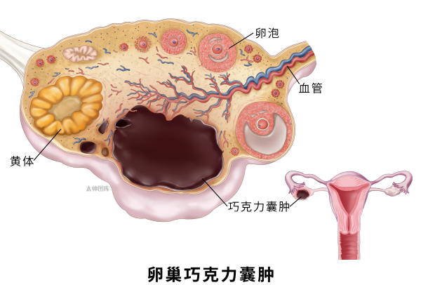 七年求子路,终获新生:一例巧囊患者的助孕手记