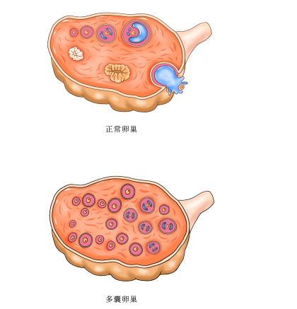 输卵管异常+PCOS+弱精症，40岁王女士的3年求子路