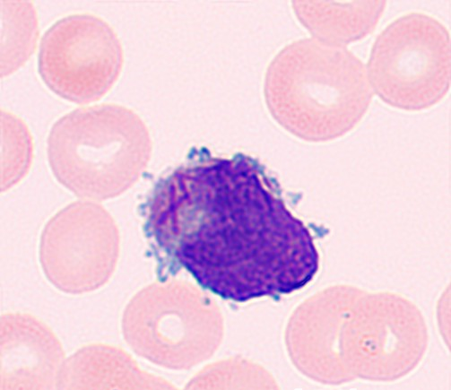 异常早幼粒细胞