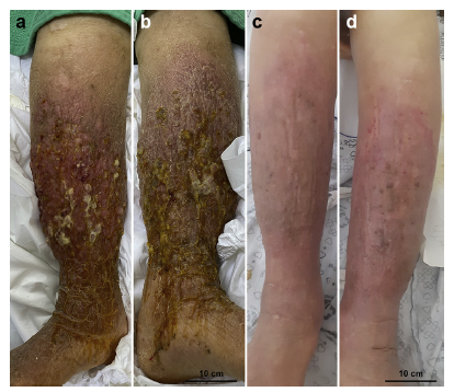 由于皮损常与蜂窝组织炎,接触性皮炎和色素性紫癜皮肤病相似,所以皮肤
